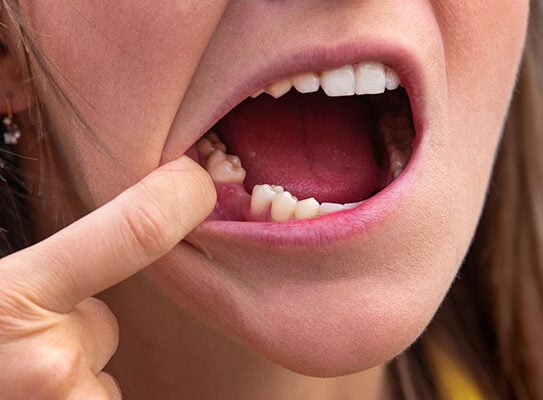 dental implants Palo Alto