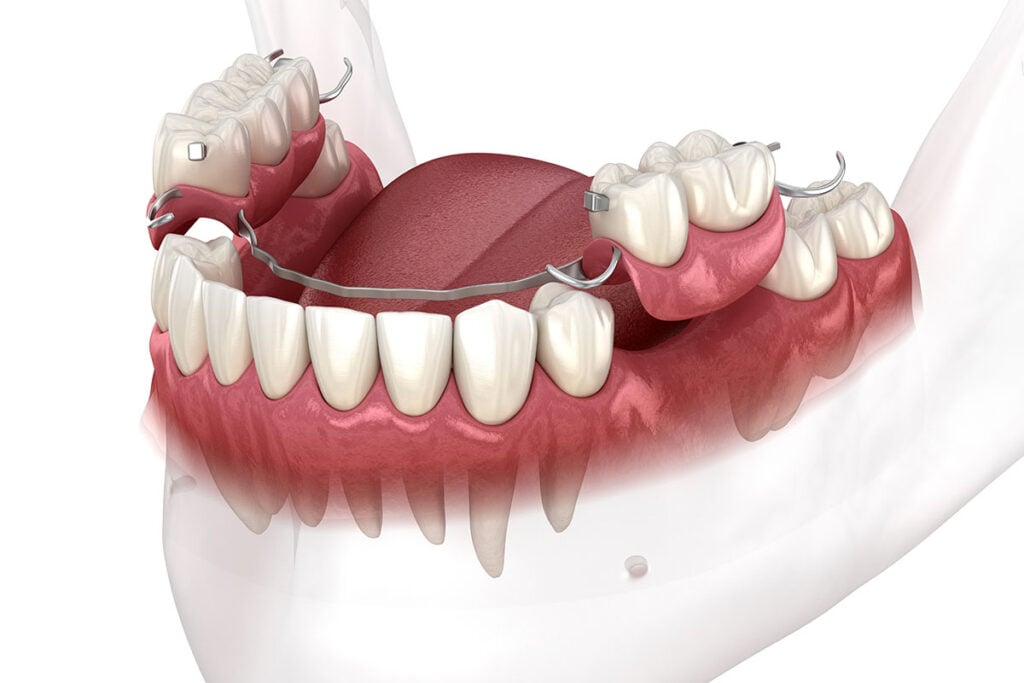 removable partial dentures flippers dentures Palo Alto