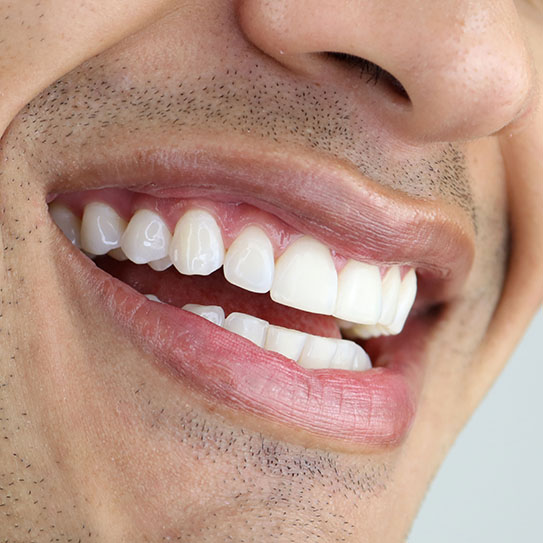 cosmetic dentist Palo Alto teeth whitening