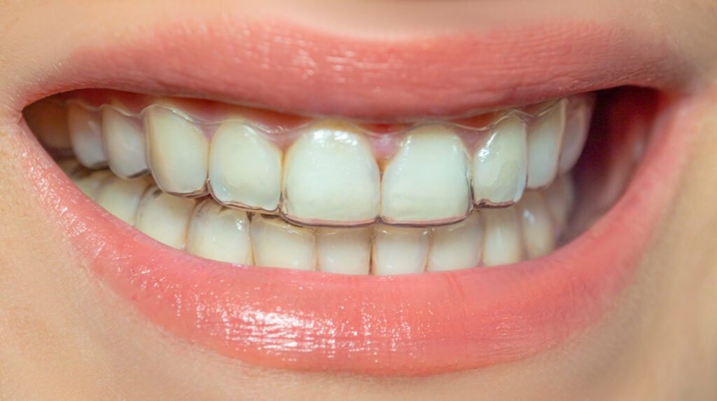 dentists in palo alto Invisalign