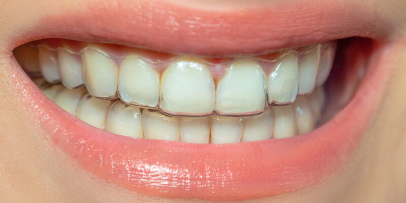 dentists in palo alto Invisalign