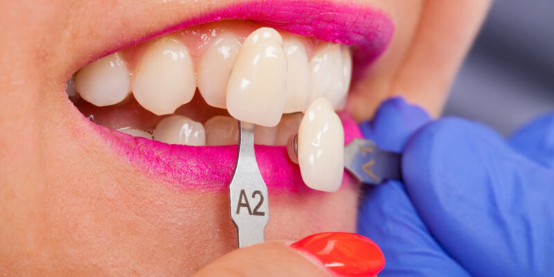 Palo Alto dentistry veneers