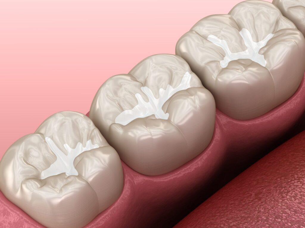 dentists in palo alto dental sealants