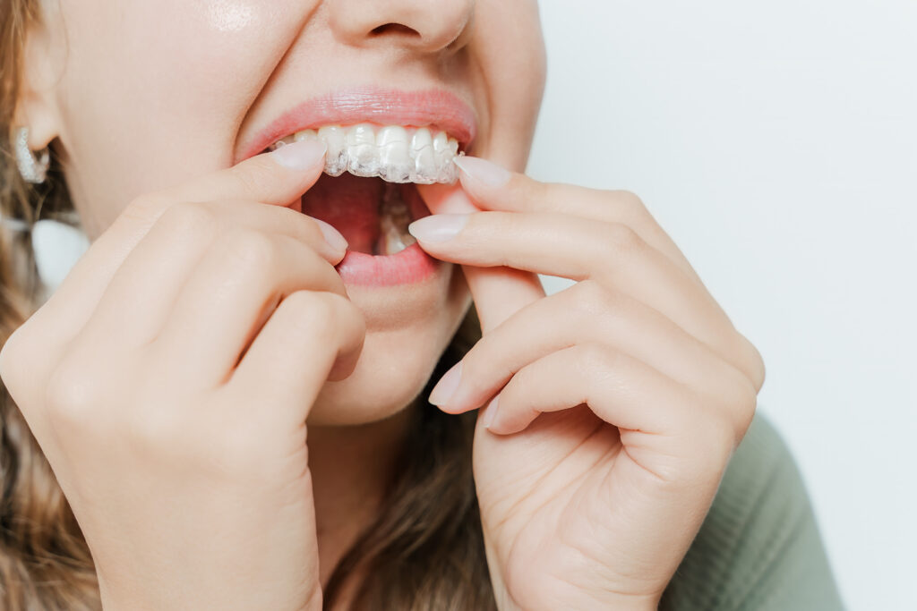 Invisalign in Palo Alto, Invisalign tips