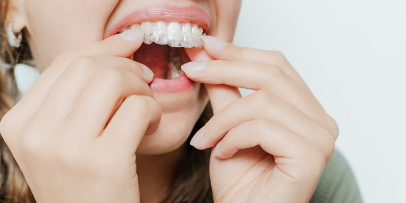 Invisalign in Palo Alto, Invisalign tips